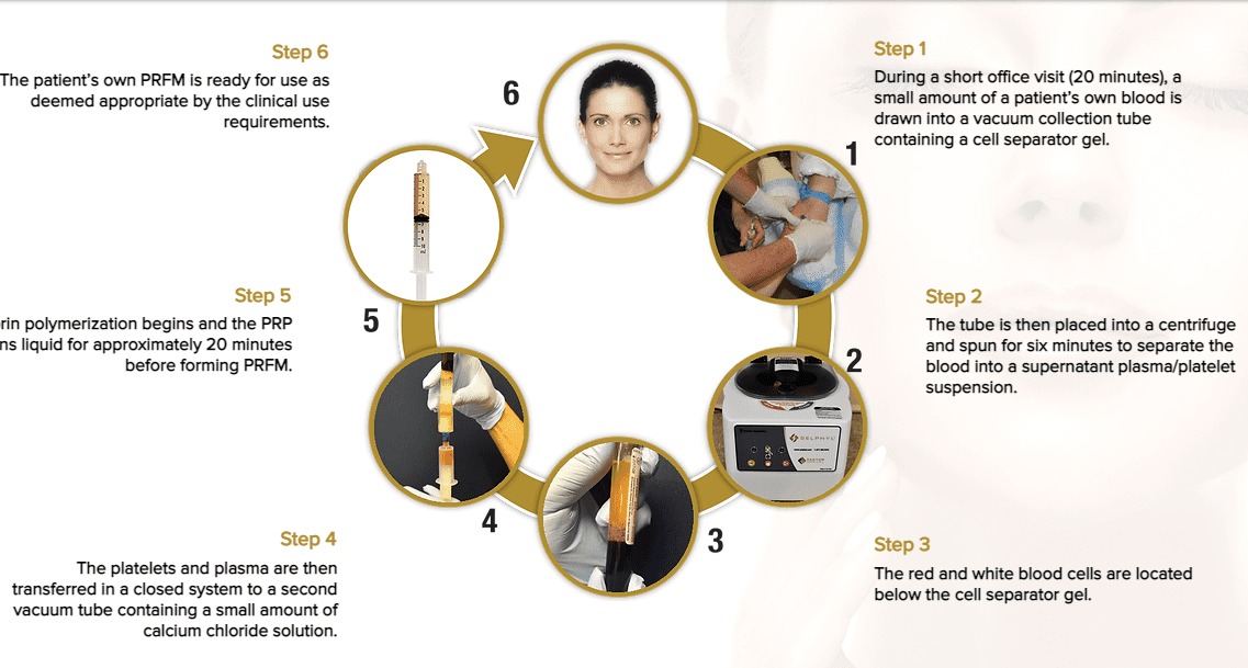 P shot for erectile dysfunction infographic